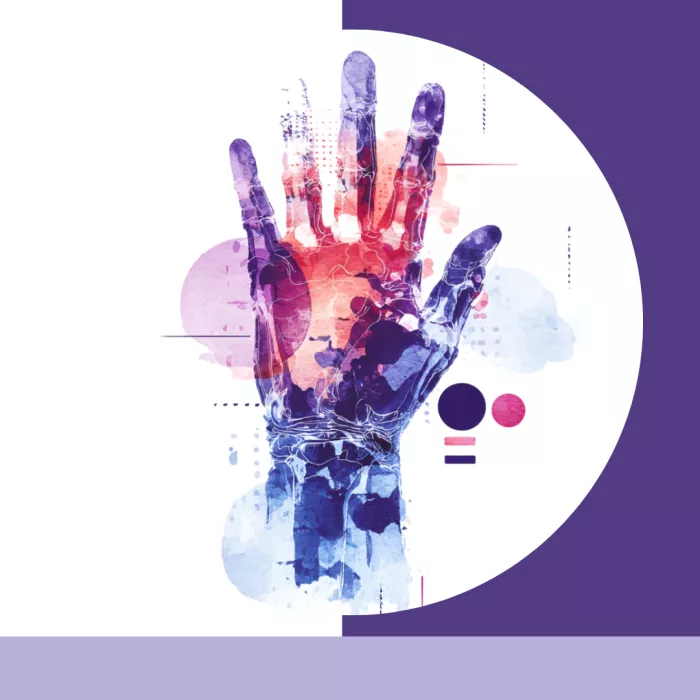 Discovery and first use of cortisone in rheumatoid arthritis